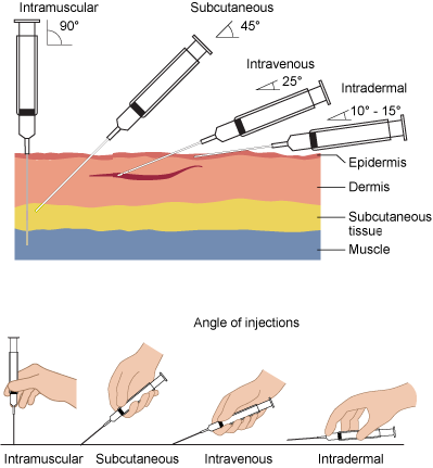 Needle-insertion-angles-1_(edited).png